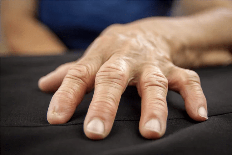 In gout, the joints of the fingers become warm to the touch, swollen and painful. 