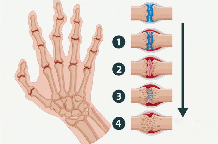 Stages of rheumatoid arthritis that affect the joints of the fingers