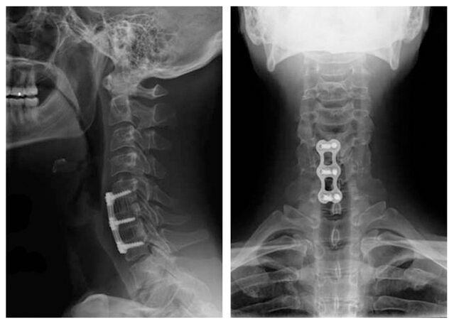 Picture after vertebral treatment