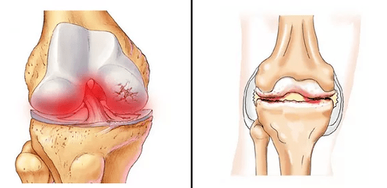 Comparison of arthritis arthritis