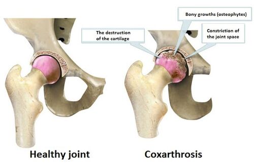 Healthy wrist affected by coxartrosis compound