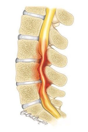 In osteochondrosis of the thoracic spine compression of the spinal canal occurs