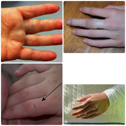 Finger bruises and fractures are characterized by pain and swelling in the joints