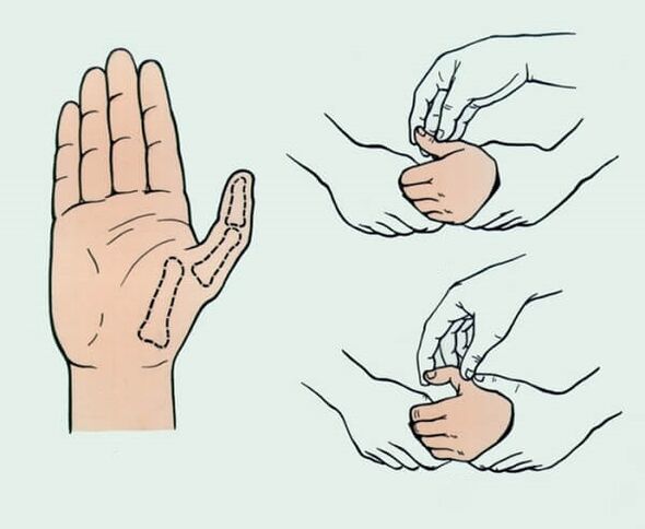 Reduction of a dislocated finger, necessary to eliminate pain in the joints