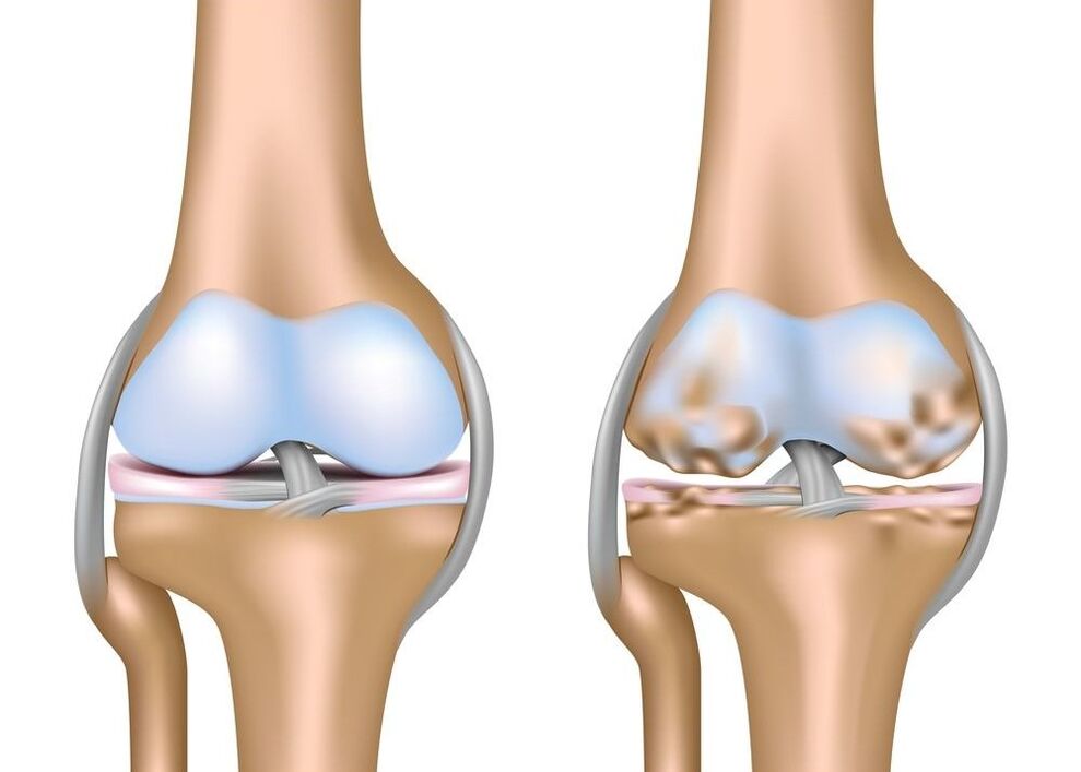 worsening of arthrosis of the joints