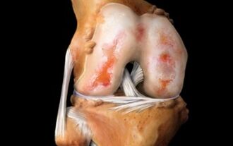 what is osteoarthritis of the knee joint