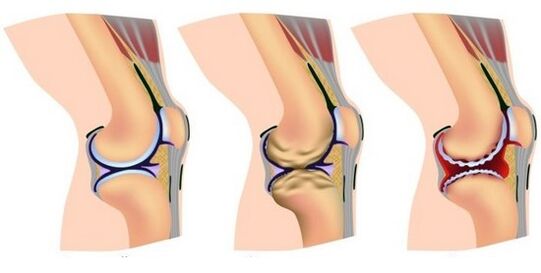 healthy joint and pain due to destruction of the knee joint