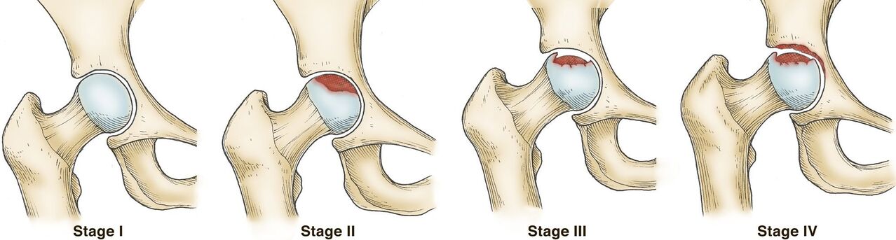 Degree of osteoarthritis of the hip joint