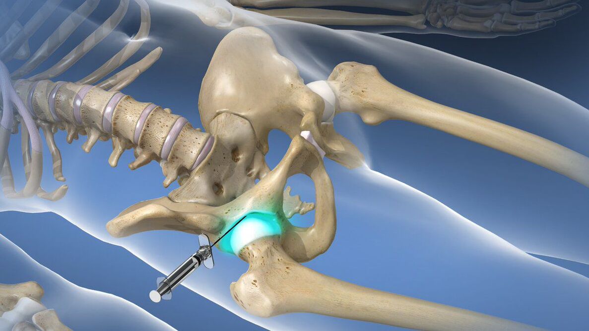 Intraarticular blockade for severe pain accompanying osteoarthritis of the hip