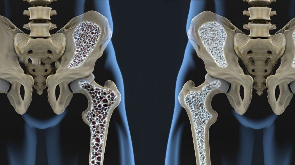 Osteoporosis is the cause of hip fractures and hip osteoarthritis