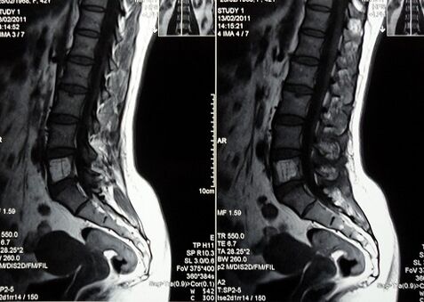 MRI of the lumbosacral spine to diagnose lower back pain